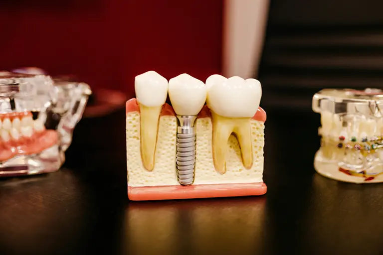Implantes dentários podem libertar partículas de titânio que dificultam a resposta imunitária